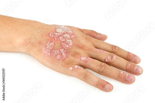 Psoriasis vulgaris on the male hand and finger nails with plaque, rash and patches, isolated on white background. Autoimmune genetic disease.