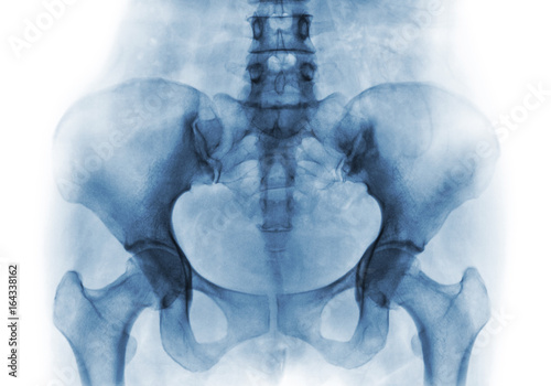 Film x-ray of normal human pelvis and hip joints