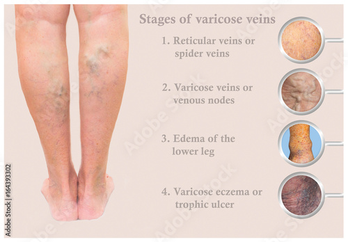 Varicose veins on a female senior leg photo