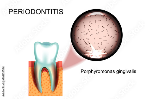periodontitis. Porphyromonas gingivalis photo