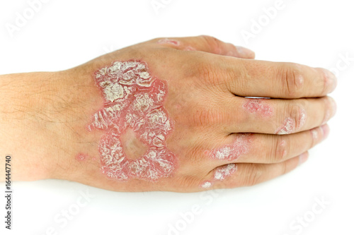 Psoriasis vulgaris and fungus on the man hand and fingers with plaque, rash and patches, isolated on white background. Autoimmune genetic disease. photo