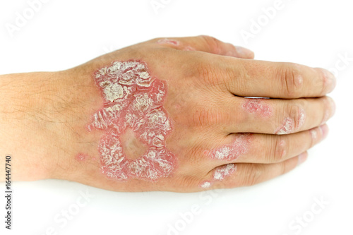 Psoriasis vulgaris and fungus on the man hand and fingers with plaque, rash and patches, isolated on white background. Autoimmune genetic disease.