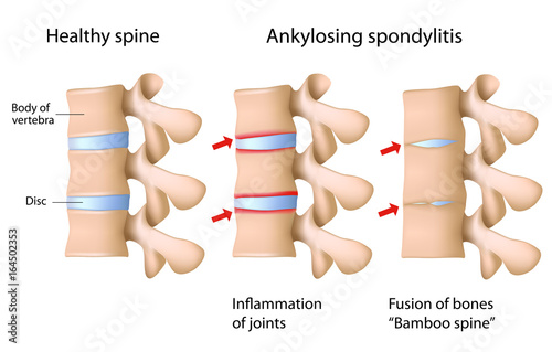 Ankylosing spondylitis of the spine photo