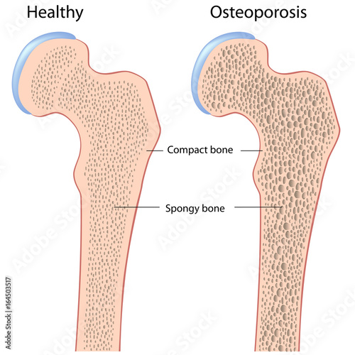 Osteoporosis of hip bone (femur)