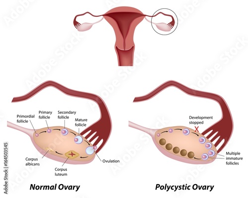Normal ovary and Polycystic ovary syndrome photo