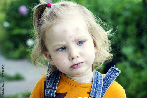 Девочка с пятнами на лице. Портрет девочки с аллергией. 