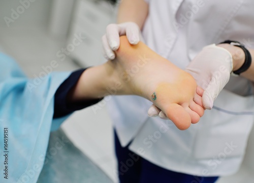 Doctor dermatologist examines the wart on the patient's foot