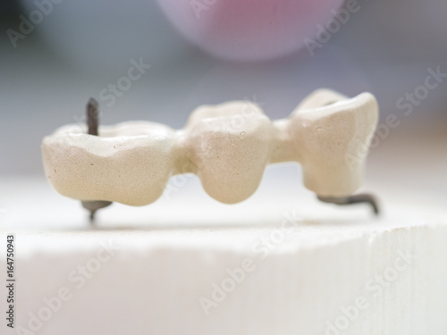 mplants teeth made in the technic Opaque porcelain dental. Oxidized metal opaque. photo