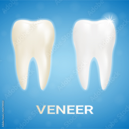 Tooth Veneer Whitening Dental Technician Isolated On A Background. Realistic Vector Illustration. Healthcare stomatology and cleaning professional teeth illustration