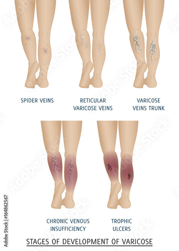 Types of varicose veins in women. Stages of development of varicose veins, vector illustration.