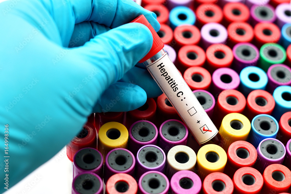 Blood sample positive with hepatitis C virus - obrazy, fototapety, plakaty 