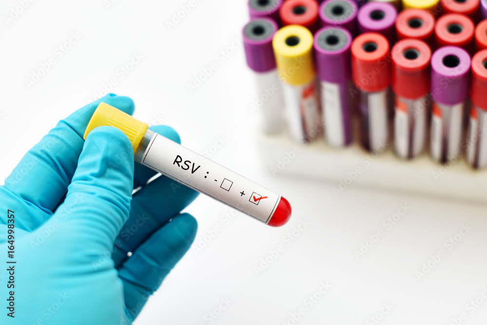Obraz premium Blood sample positive with respiratory syncytial virus (RSV)