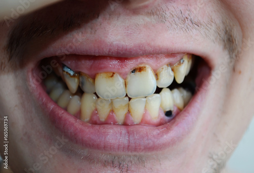 issues for Oral Care, Caries, tartar, gum disease, dental problems, bad teeth, dental problems, dentistry