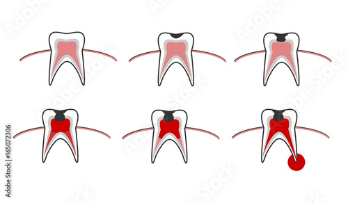 Vector illustration of the stages of caries on the teeth. Dental chart