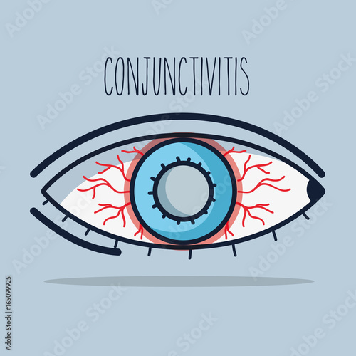 conjunctivitis allergic inflammation of vision eye