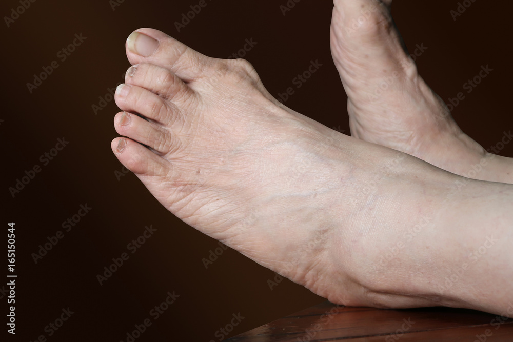 Fototapeta premium Bunion - hallux valgus on brown background