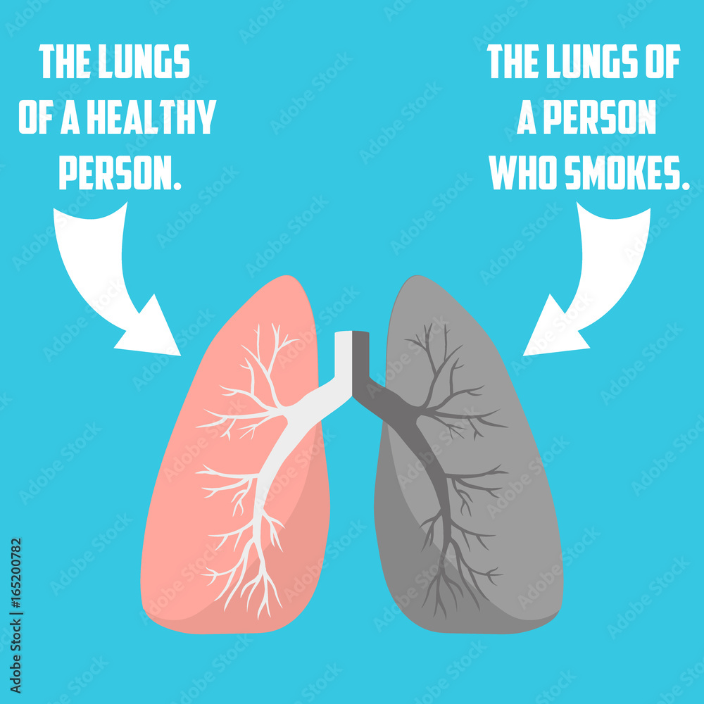 Normal lung and lung cancer illustration Normal lung and lung cancer illustration