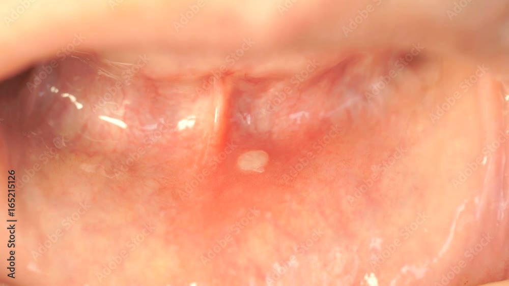 Close-up of stomatitis into mouth. Woman bends his lower lip and shows stomatitis Close-up of stomatitis into mouth. Woman bends his lower lip and shows stomatitis