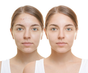 Beautiful young woman with problem skin on white background