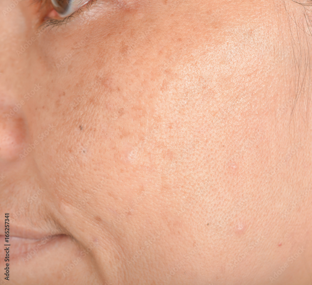 Freckles on the face Freckles on the face