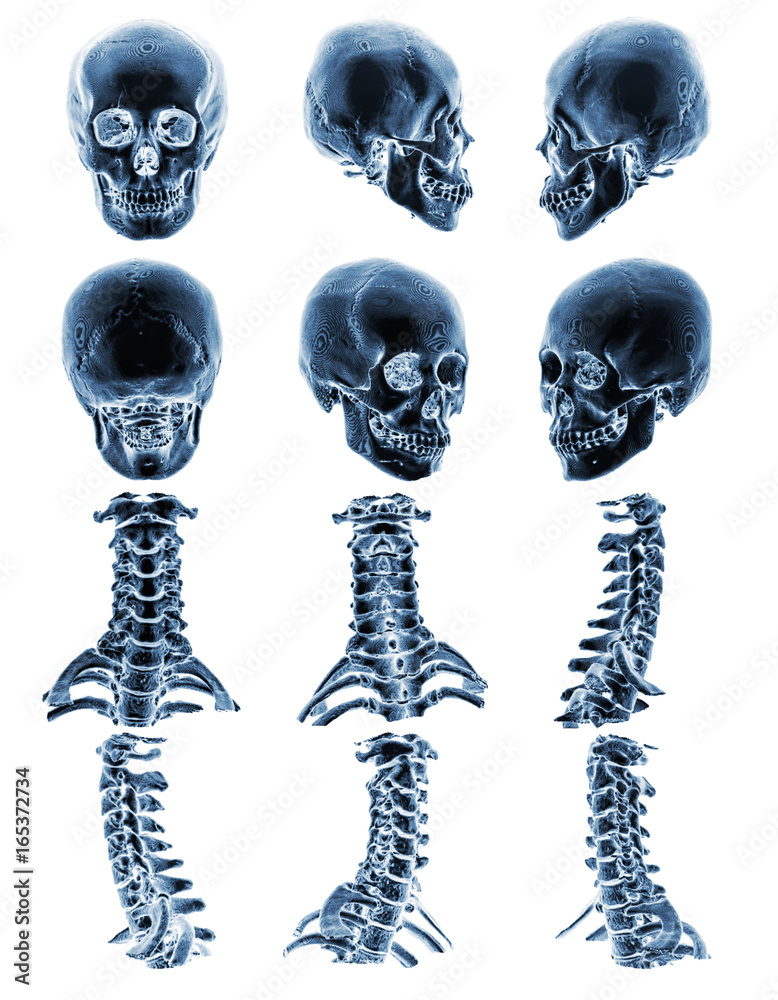 CT scan ( Computed tomography ) with 3D graphic show normal human skull and cervical spine CT scan ( Computed tomography ) with 3D graphic show normal human skull and cervical spine