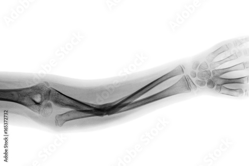 Obraz na płótnie Film x-ray forearm AP show fracture shaft of ulnar bone