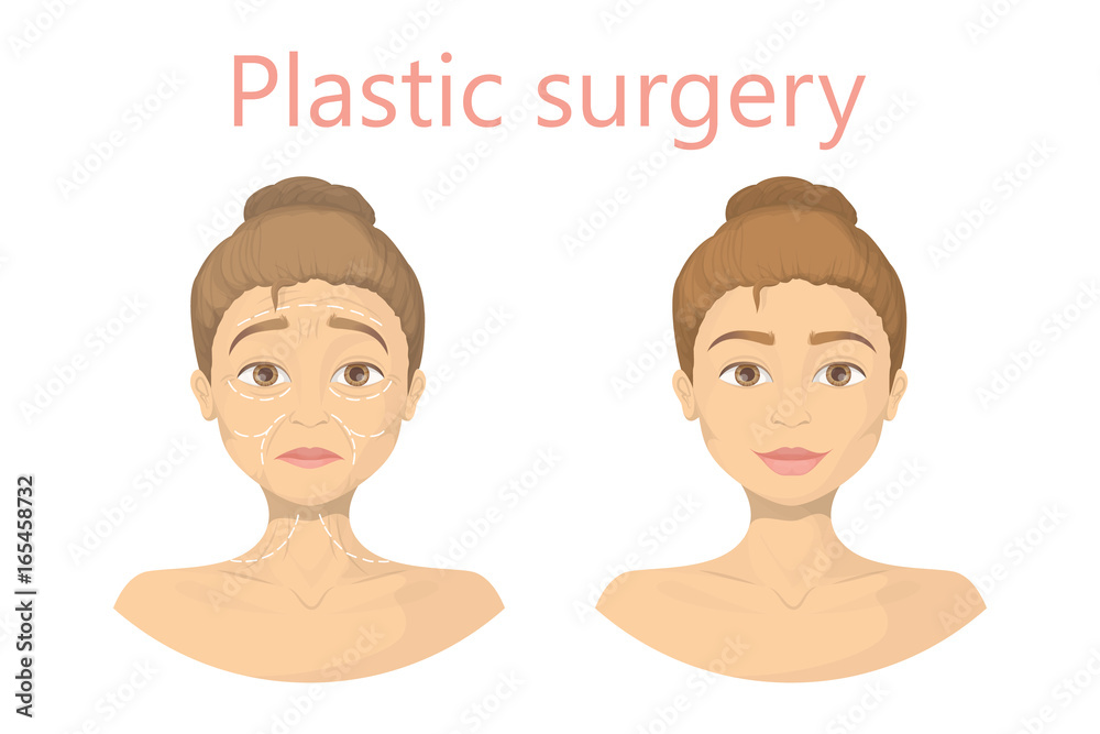 Face plastic surgery. Face plastic surgery.