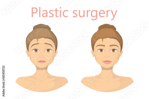 Face plastic surgery.