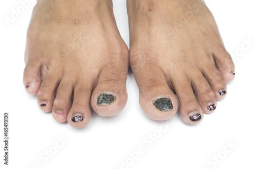 Fungi at toenail , Nails are not beautiful