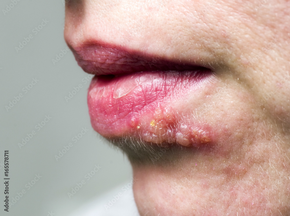 Naklejka premium Herpes on lip