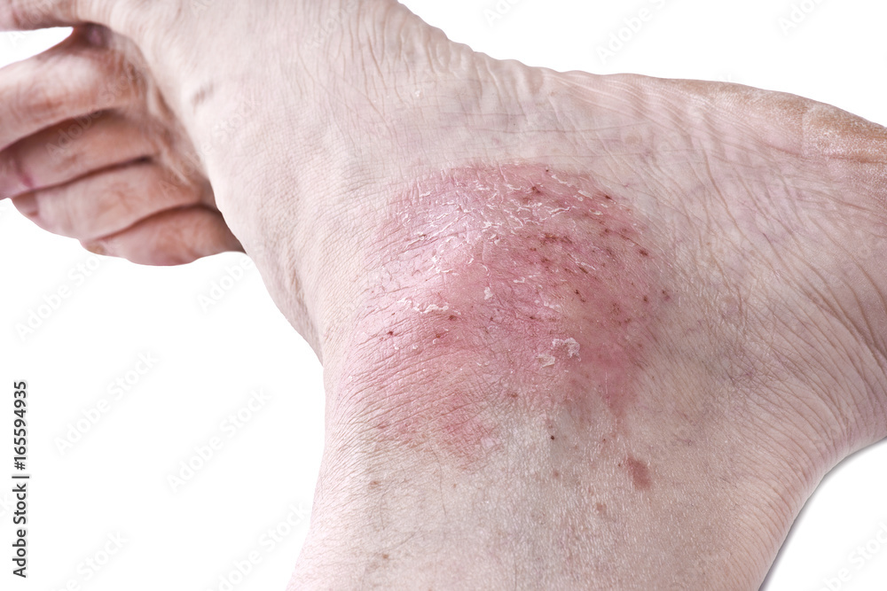 Psoriasis, skin disease on the joints of the body Psoriasis, skin disease on the joints of the body