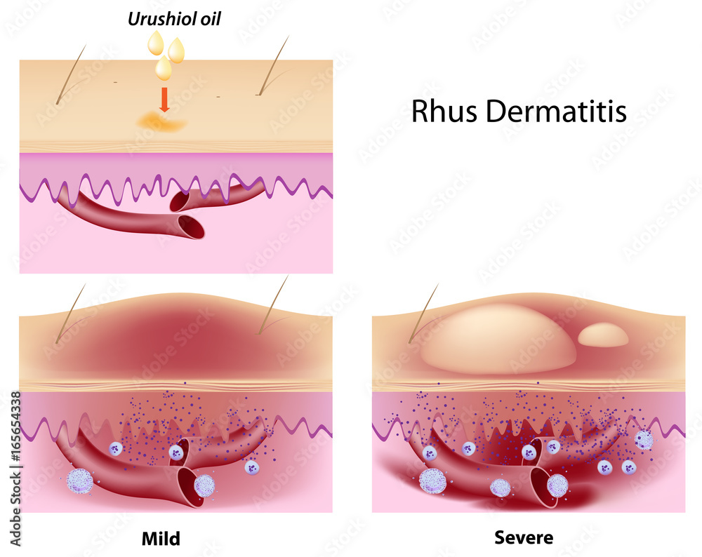 Φωτογραφία Urushiol oil induced contact dermatitis