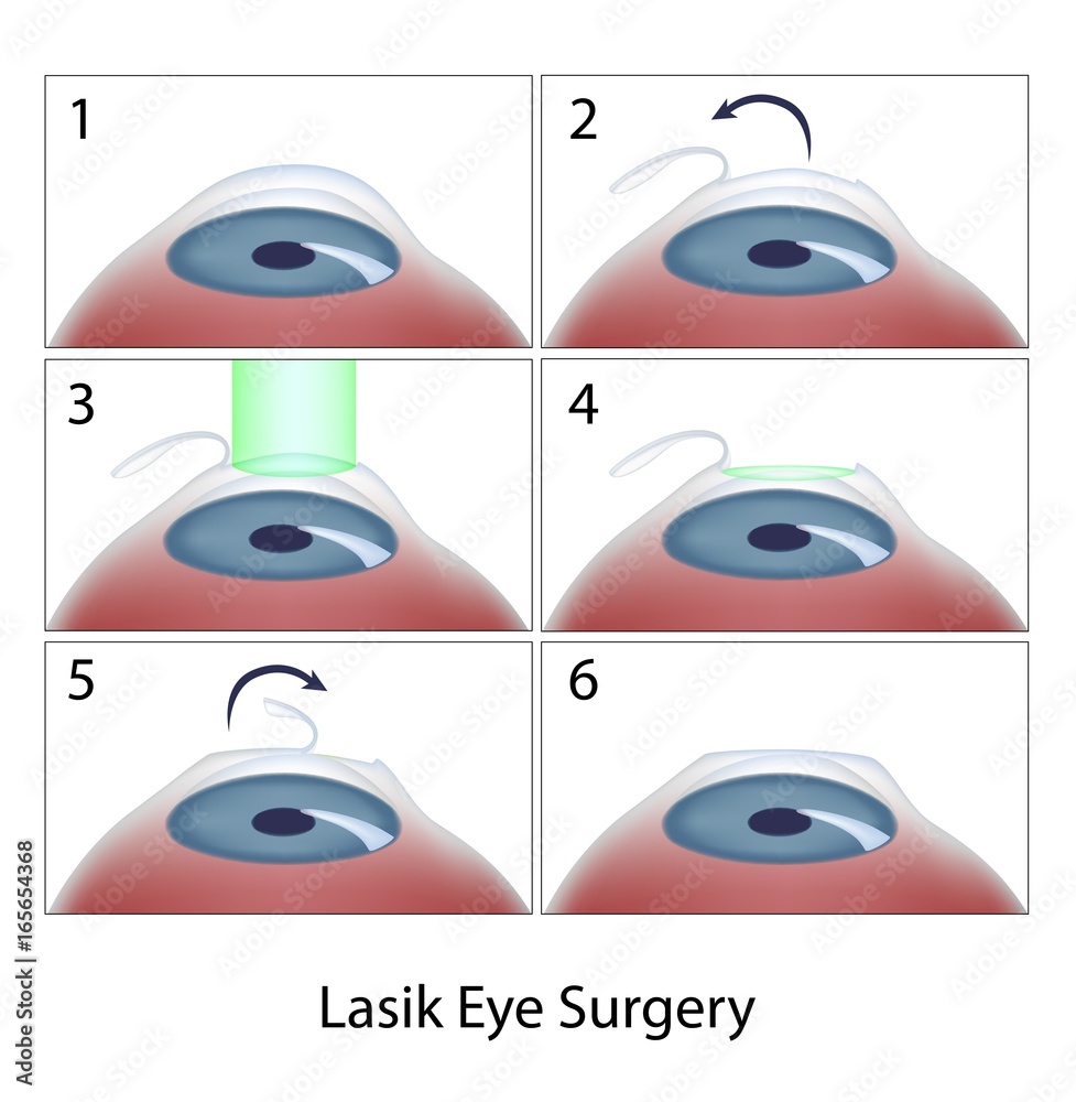 Obraz na plátně Lasik eye surgery procedure