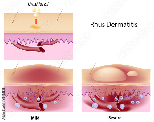Canvas Print Urushiol oil induced contact dermatitis
