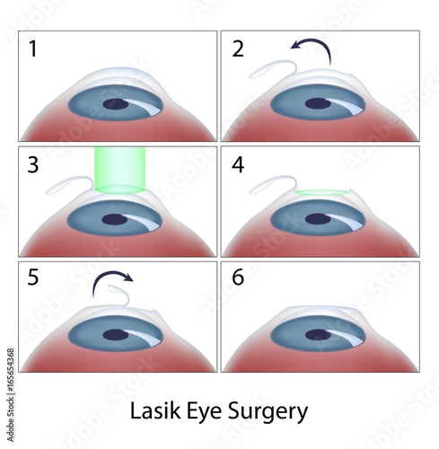 Lasik eye surgery procedure photo