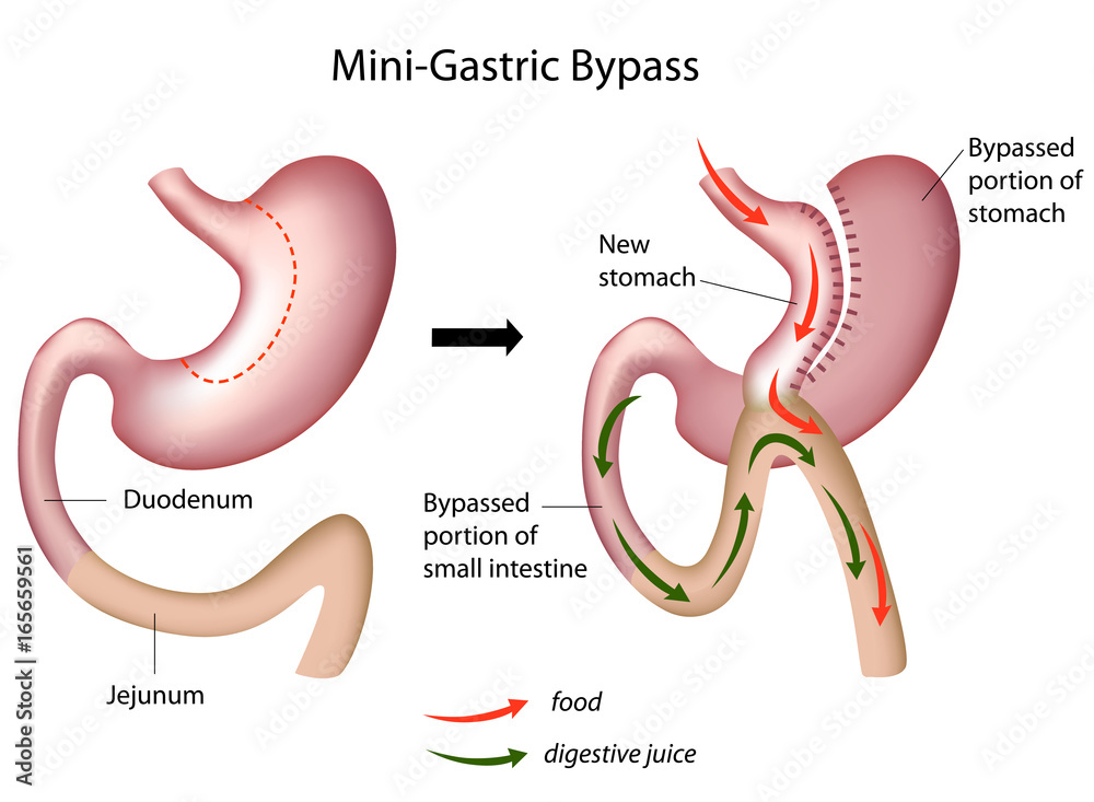 Фотография Mini gastric bypass surgery, labeled.