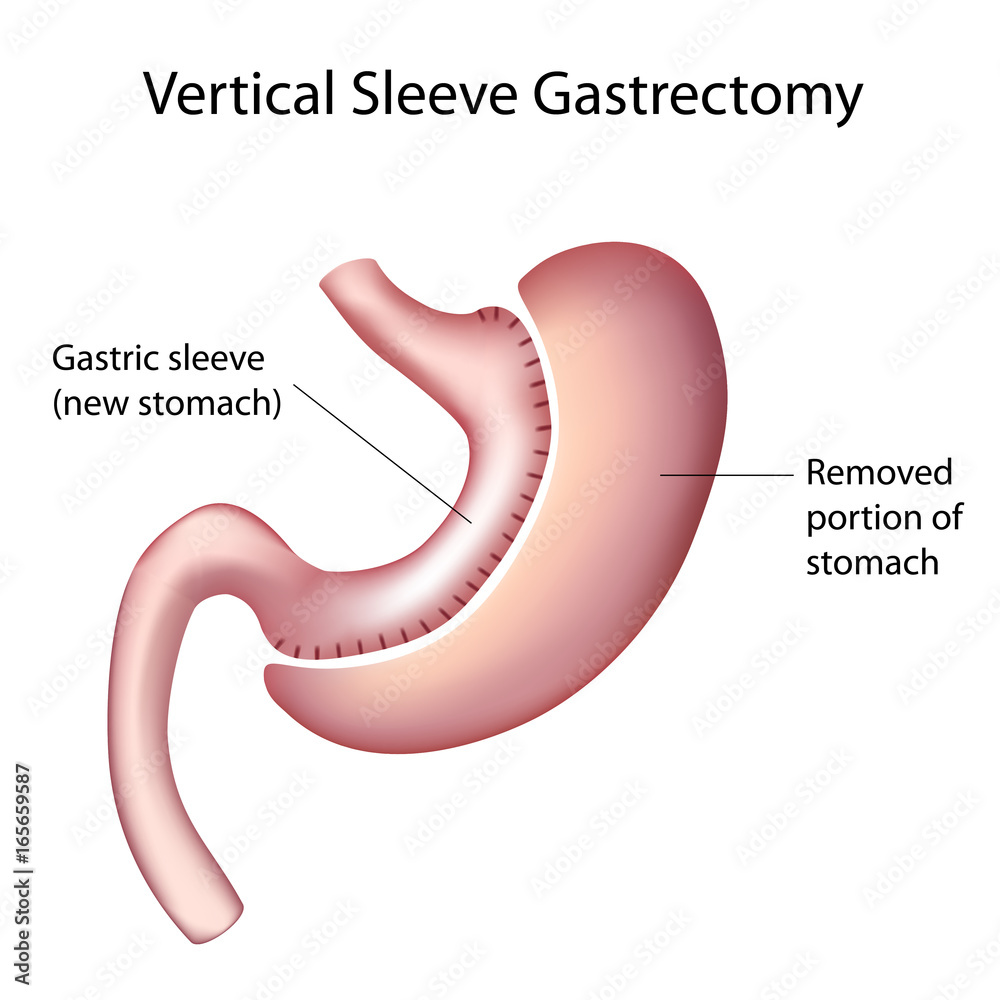 Vertical Sleeve Gastrectomy (VSG), labeled. Stock Illustration Adobe