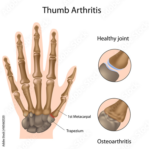 Base of thumb arthritis photo