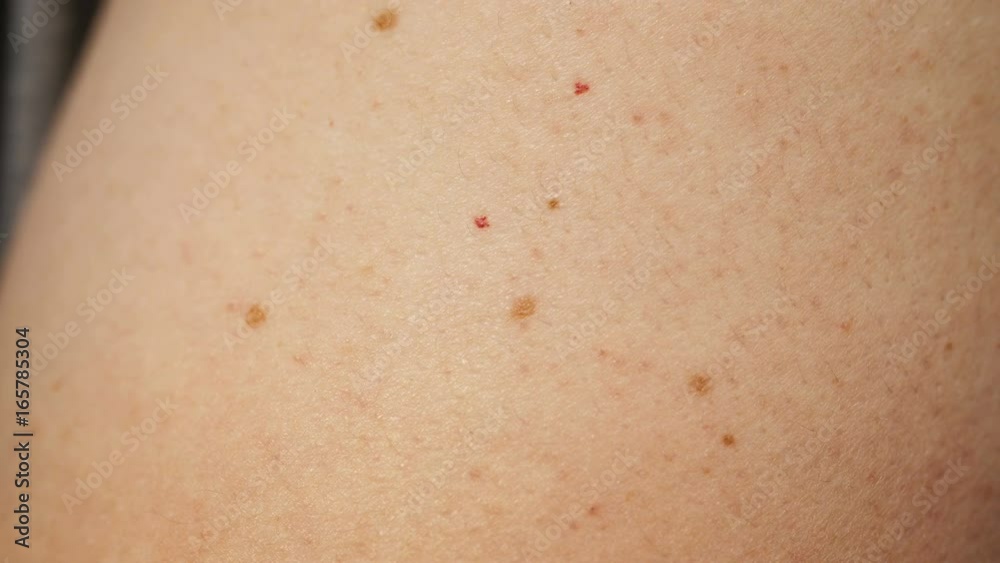Skin with a lot of moles Skin with a lot of moles