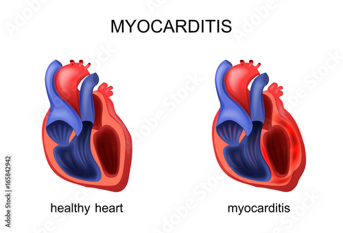 heart healthy and diseased myocarditis photo