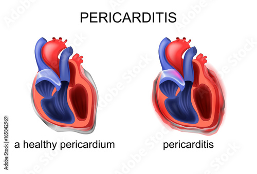 a healthy pericardium, pericarditis photo