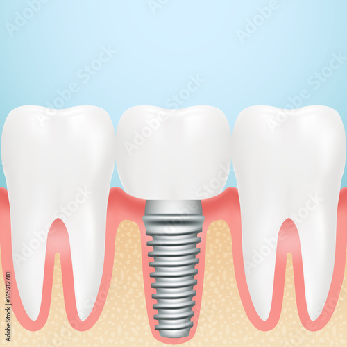 Realistic Dental Implant. Installation Of Dental Implant With All Parts Crown, Abutment, Screw Isolated On A Background. Vector Illustration. Stomatology. Creative Medical Concept