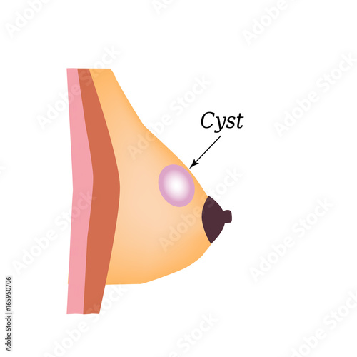 Cyst in the mammary gland. World Breast Cancer Day. Vector illustration on isolated background