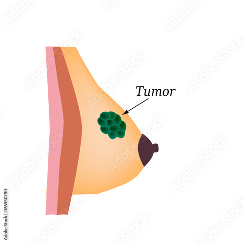Tumor in the mammary gland. World Breast Cancer Day. Vector illustration on isolated background
