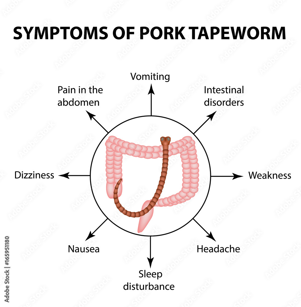 Symptoms of Pork tapeworm. Infographics. Vector illustration on isolated  background Stock Vector | Adobe Stock
