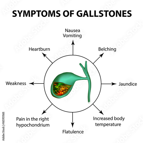Symptoms of stones in the gallbladder. Infographics. Vector illustration on isolated background