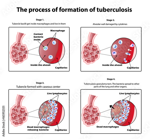 The process of tuberculosis formation. Infographics. Vector illustration on isolated background.