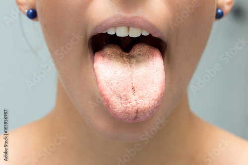 Candida albicans infection on tongue of woman