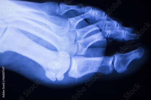 Foot toes xray test scan