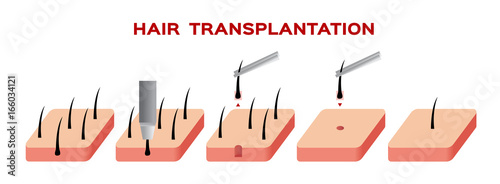 hair transplant vector photo